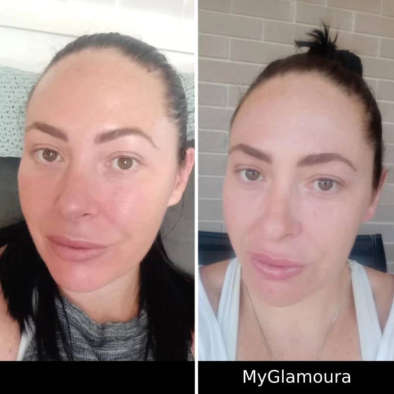 قناع العلاج بالضوء GLED Pro ©